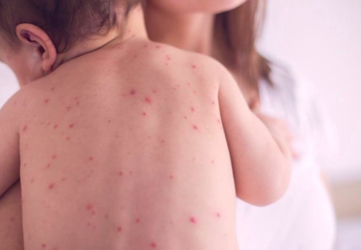 Улаанбурхан өвчний батлагдсан тохиолдол 2828 боллоо